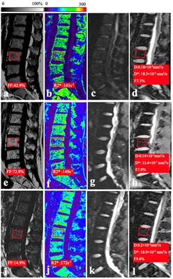 Quantitative Dixon and intravoxel incoherent motion diffusion magnetic resonance imaging parameters in lumbar vertebrae for differentiating aplastic anemia and acute myeloid leukemia